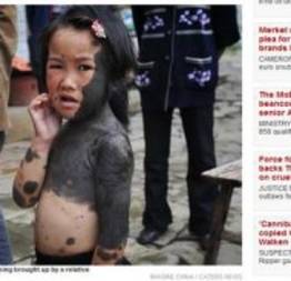 Chinesa de seis anos tem corpo coberto por pele preta e não consegue fazer amigo