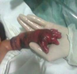 Bebê que quase perdeu o braço foi transferido para hospital em salvador